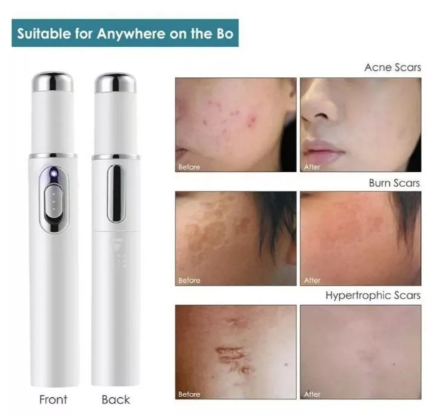 Lápiz de Fototerapia Luz Azul Pro – Tratamiento Facial de Alta Precisión y Masaje Sónico